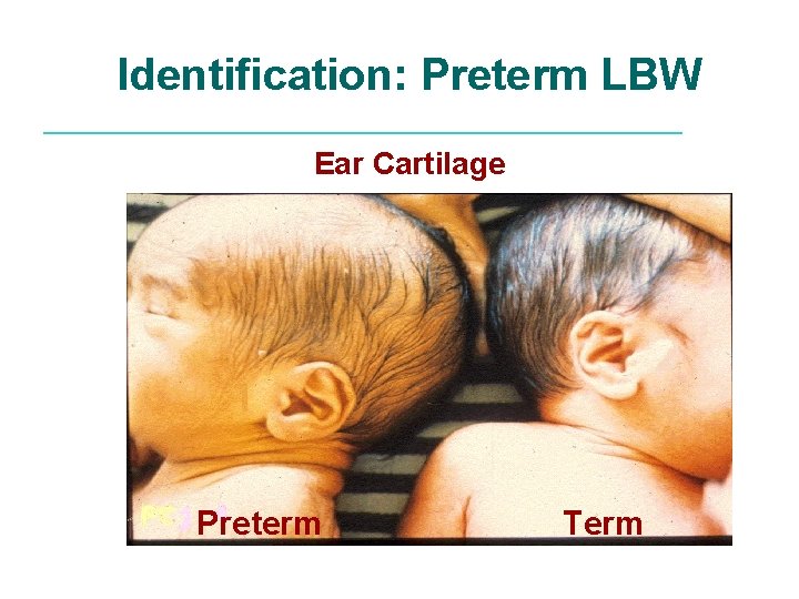 Identification: Preterm LBW Ear Cartilage Preterm Term 