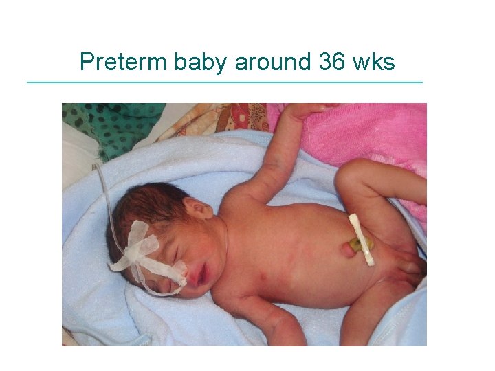 Preterm baby around 36 wks 