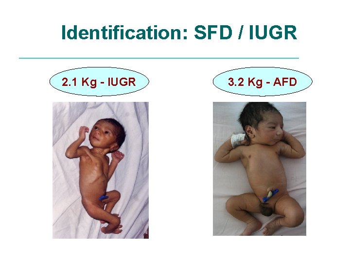 Identification: SFD / IUGR 2. 1 Kg - IUGR 3. 2 Kg - AFD