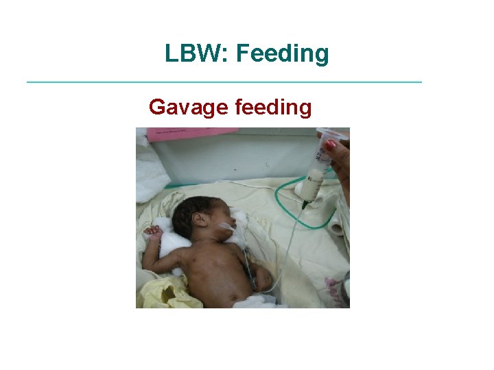 LBW: Feeding Gavage feeding 