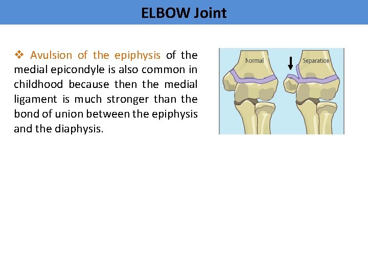 ELBOW Joint v Avulsion of the epiphysis of the medial epicondyle is also common