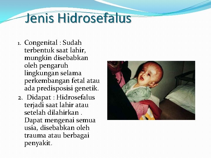 Jenis Hidrosefalus Congenital : Sudah terbentuk saat lahir, mungkin disebabkan oleh pengaruh lingkungan selama