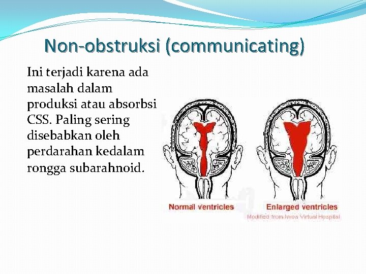 Non-obstruksi (communicating) Ini terjadi karena ada masalah dalam produksi atau absorbsi CSS. Paling sering