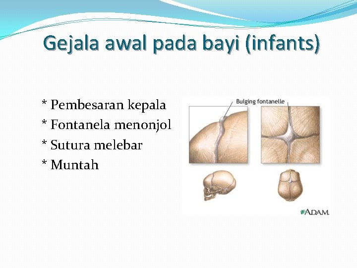 Gejala awal pada bayi (infants) * Pembesaran kepala * Fontanela menonjol * Sutura melebar