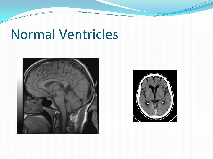 Normal Ventricles 