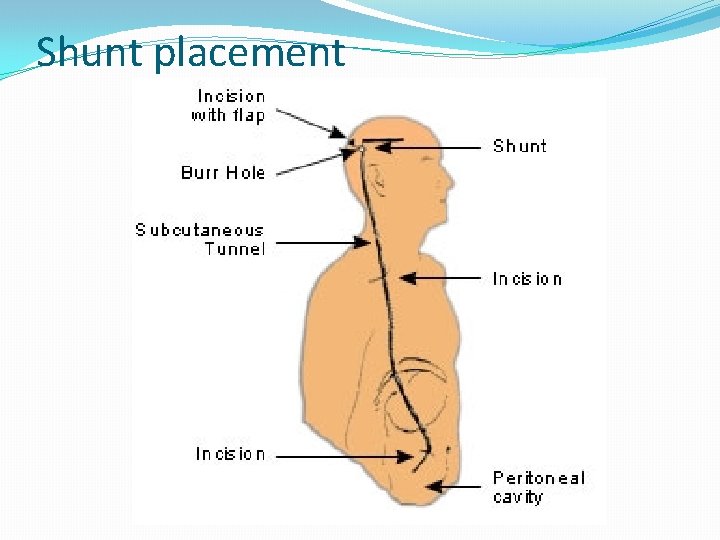 Shunt placement 