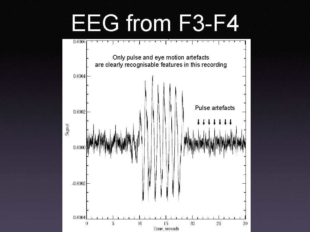 EEG from F 3 -F 4 Only pulse and eye motion artefacts are clearly