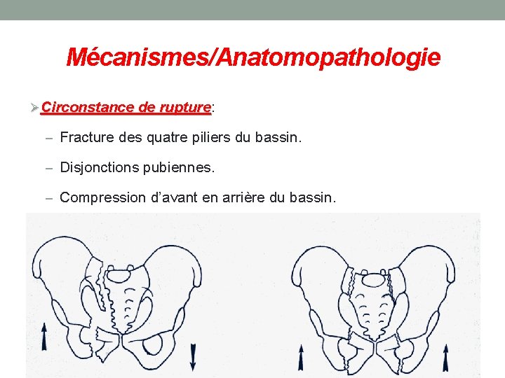 Mécanismes/Anatomopathologie ØCirconstance de rupture: Circonstance de rupture – Fracture des quatre piliers du bassin.