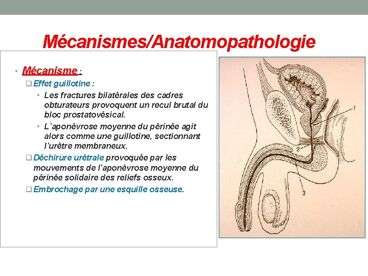 Mécanismes/Anatomopathologie • Mécanisme : q Effet guillotine : • Les fractures bilatérales des cadres
