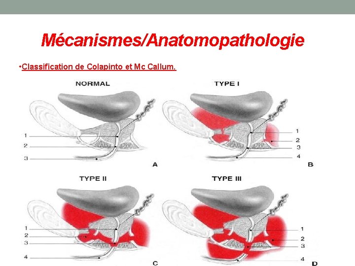 Mécanismes/Anatomopathologie • Classification de Colapinto et Mc Callum. 