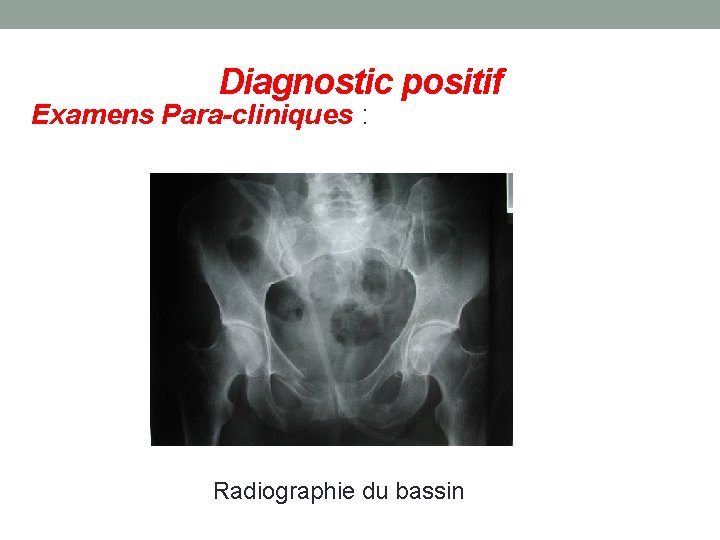 Diagnostic positif Examens Para-cliniques : Radiographie du bassin 