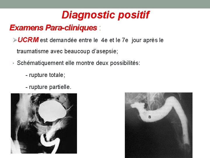 Diagnostic positif Examens Para-cliniques : ØUCRM est demandée entre le 4 e et le