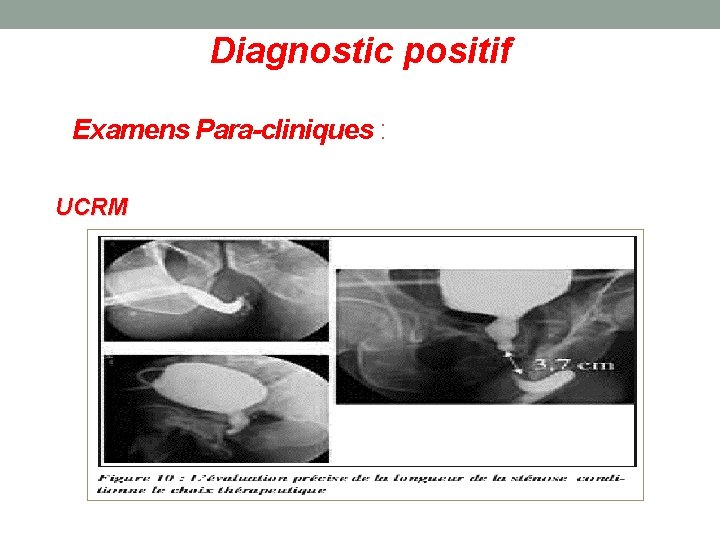 Diagnostic positif Examens Para-cliniques : UCRM 