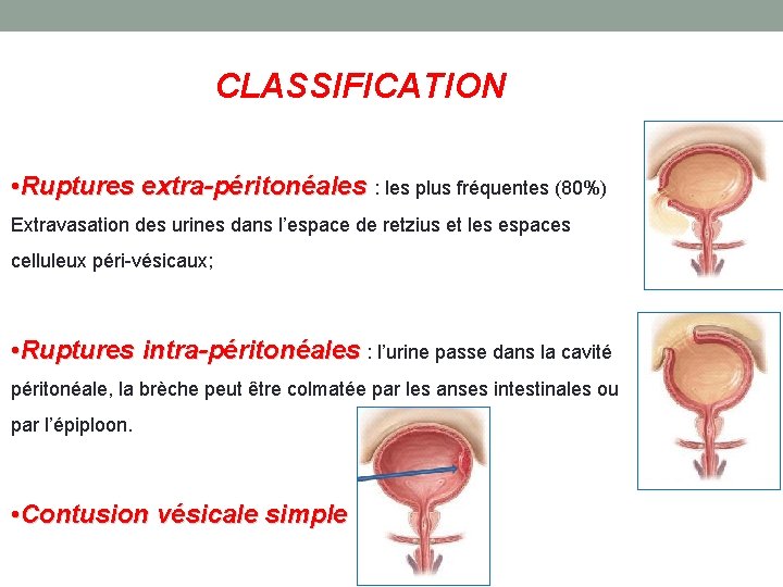  CLASSIFICATION • Ruptures extra-péritonéales : les plus fréquentes (80%) Extravasation des urines dans