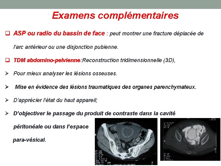  Examens complémentaires q ASP ou radio du bassin de face : peut montrer