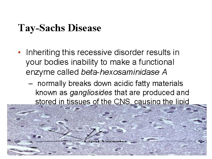 Tay-Sachs Disease • Inheriting this recessive disorder results in your bodies inability to make