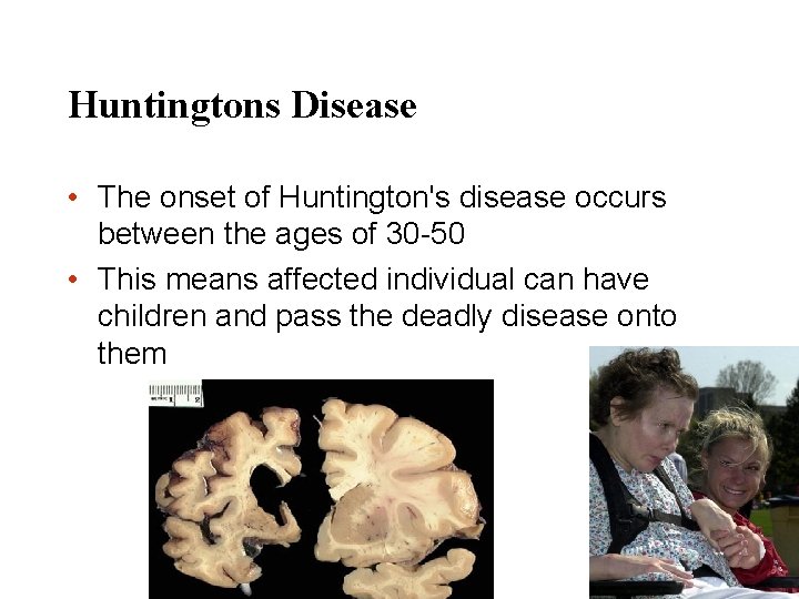 Huntingtons Disease • The onset of Huntington's disease occurs between the ages of 30