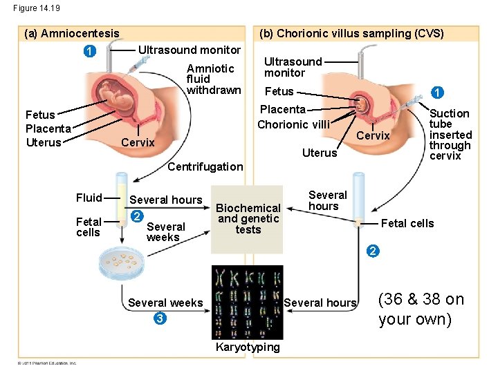 Figure 14. 19 (a) Amniocentesis 1 (b) Chorionic villus sampling (CVS) Ultrasound monitor Amniotic