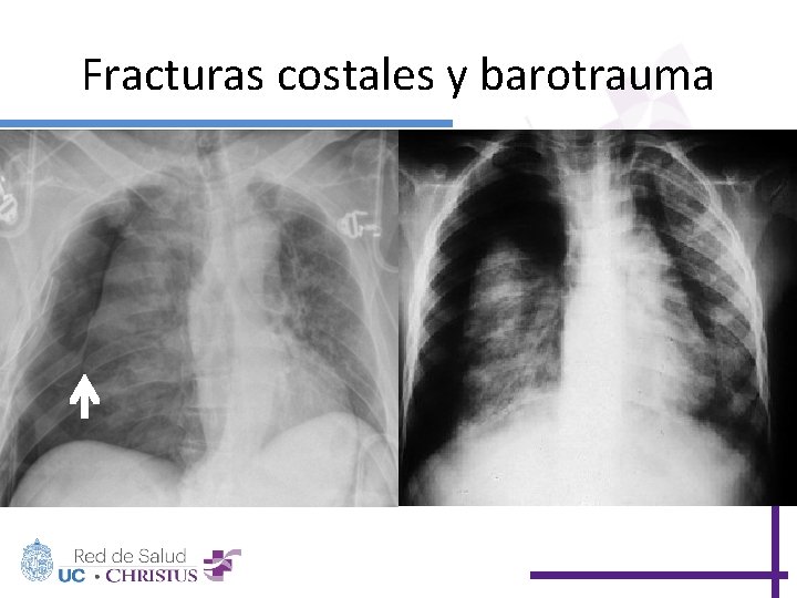 Fracturas costales y barotrauma 