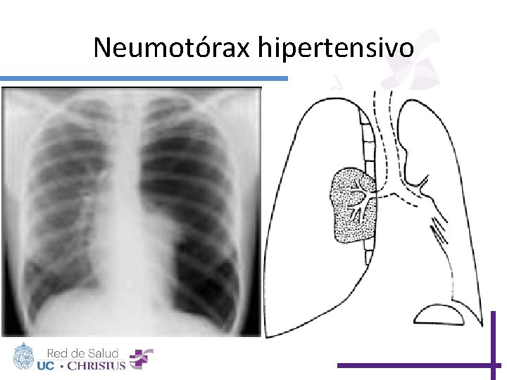 Neumotórax hipertensivo 
