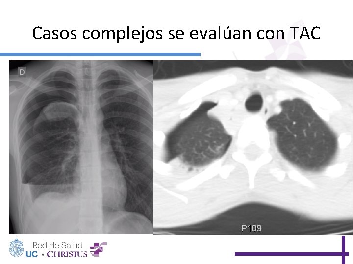 Casos complejos se evalúan con TAC 