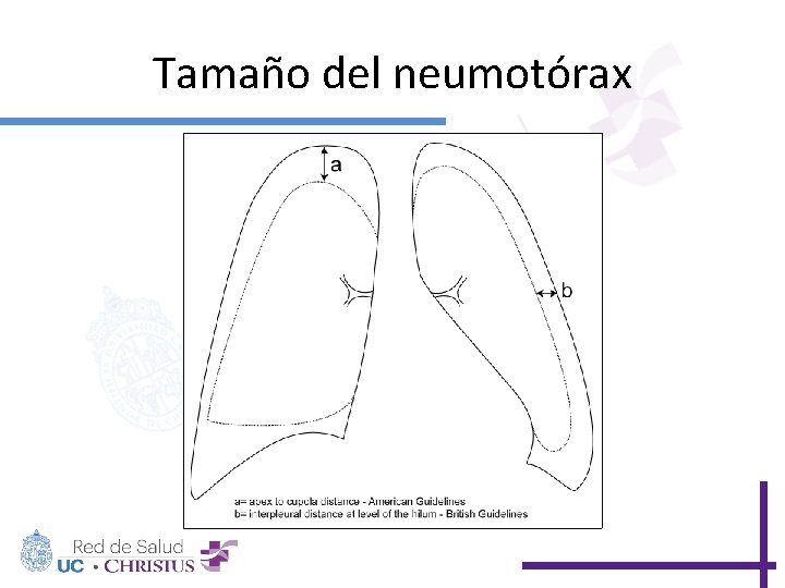 Tamaño del neumotórax 