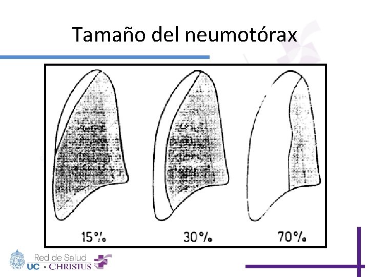 Tamaño del neumotórax 