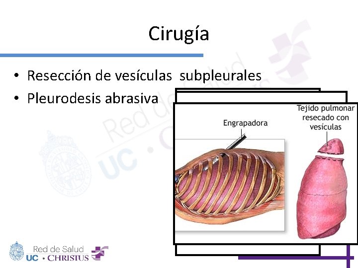 Cirugía • Resección de vesículas subpleurales • Pleurodesis abrasiva 