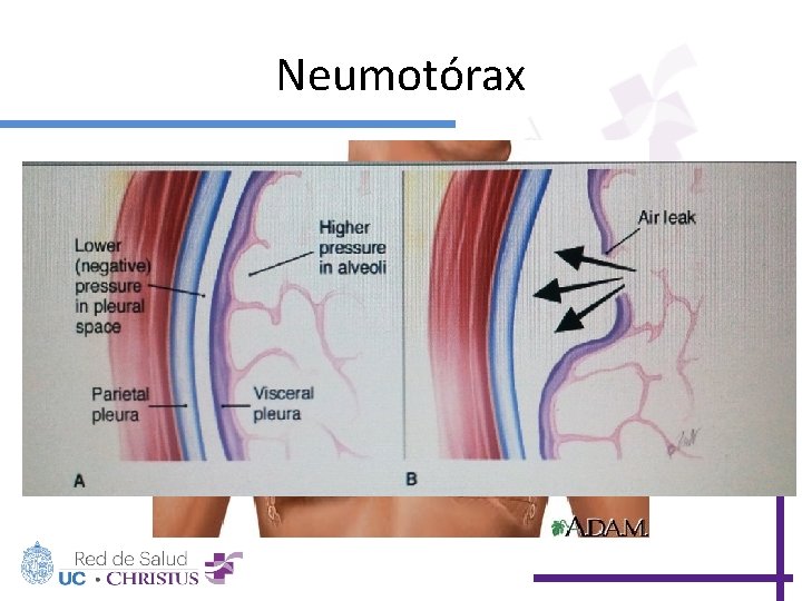 Neumotórax 