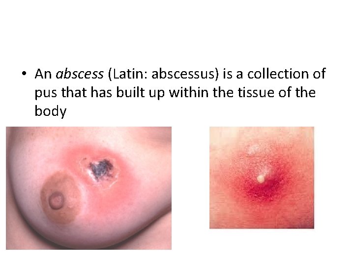  • An abscess (Latin: abscessus) is a collection of pus that has built