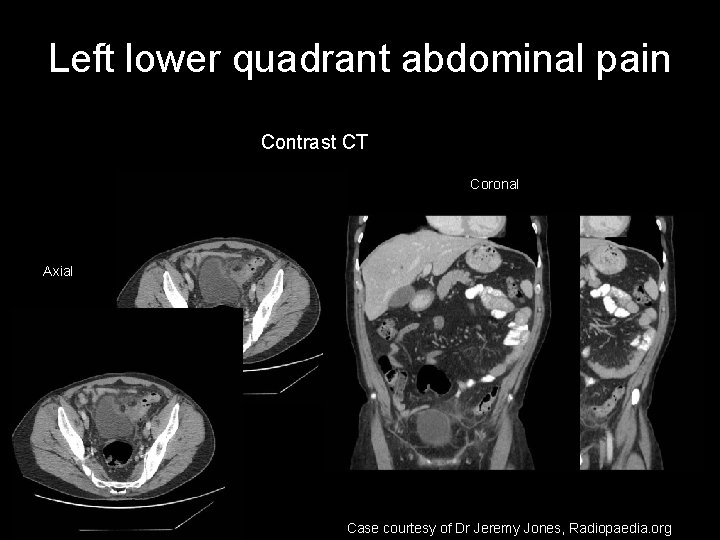 Left lower quadrant abdominal pain Contrast CT Coronal Axial Case courtesy of Dr Jeremy