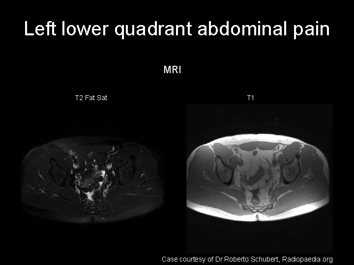 Left lower quadrant abdominal pain MRI T 2 Fat Sat T 1 Case courtesy