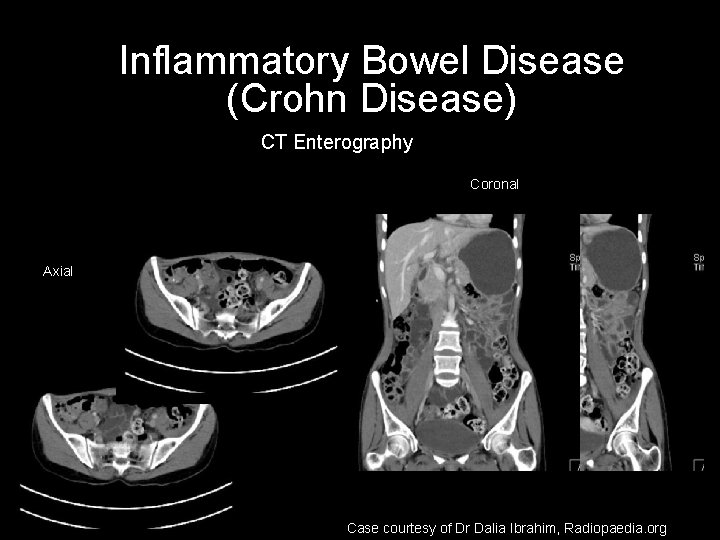 Inflammatory Bowel Disease (Crohn Disease) CT Enterography Coronal Axial Case courtesy of Dr Dalia