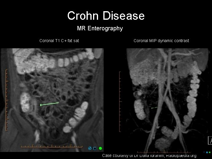 Crohn Disease MR Enterography Coronal T 1 C+ fat sat Coronal MIP dynamic contrast