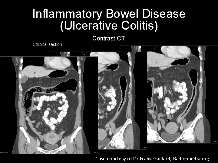 Inflammatory Bowel Disease (Ulcerative Colitis) Contrast CT Coronal section Case courtesy of Dr Frank