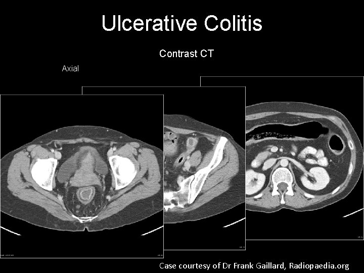 Ulcerative Colitis Contrast CT Axial Case courtesy of Dr Frank Gaillard, Radiopaedia. org 