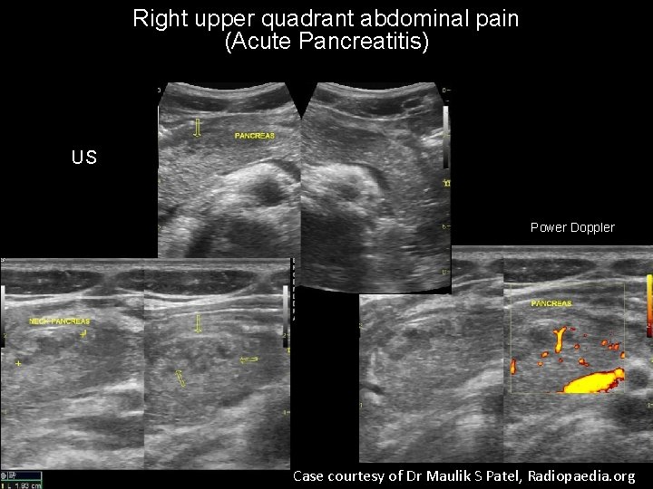 Right upper quadrant abdominal pain (Acute Pancreatitis) US Power Doppler Case courtesy of Dr