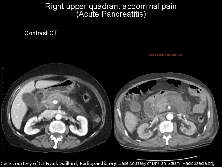 Right upper quadrant abdominal pain (Acute Pancreatitis) Contrast CT Case courtesy of Dr Frank