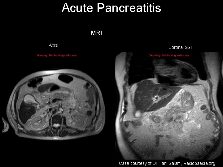 Acute Pancreatitis MRI Axial Coronal SSH Case courtesy of Dr Hani Salam, Radiopaedia. org