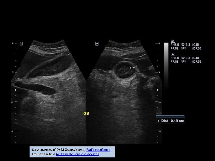 Case courtesy of Dr M Osama Yonso, Radiopaedia. org. From the article Acute acalculous