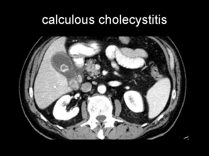 calculous cholecystitis 