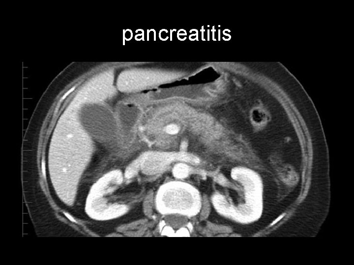 pancreatitis 