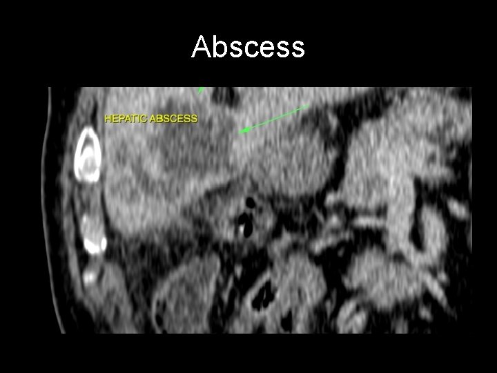 Abscess 