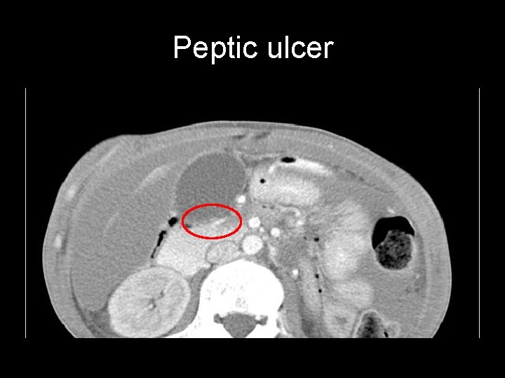 Peptic ulcer 