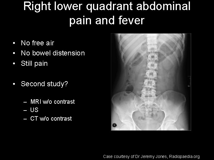 Right lower quadrant abdominal pain and fever • No free air • No bowel