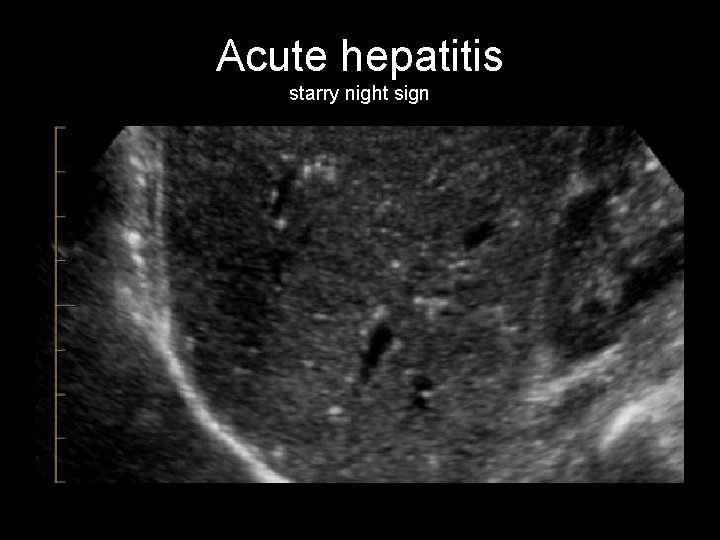 Acute hepatitis starry night sign 