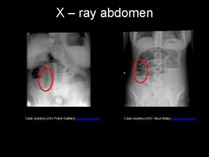 X – ray abdomen Case courtesy of Dr Frank Gaillard, Radiopaedia. org Case courtesy