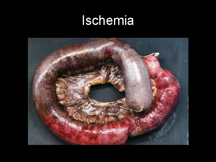 Ischemia 