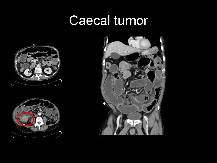 Caecal tumor 
