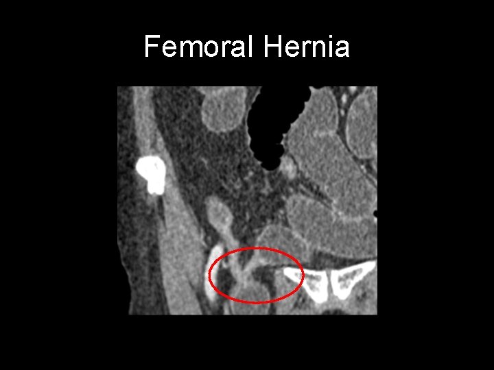 Femoral Hernia 